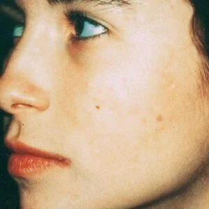 post micro acne.jpg