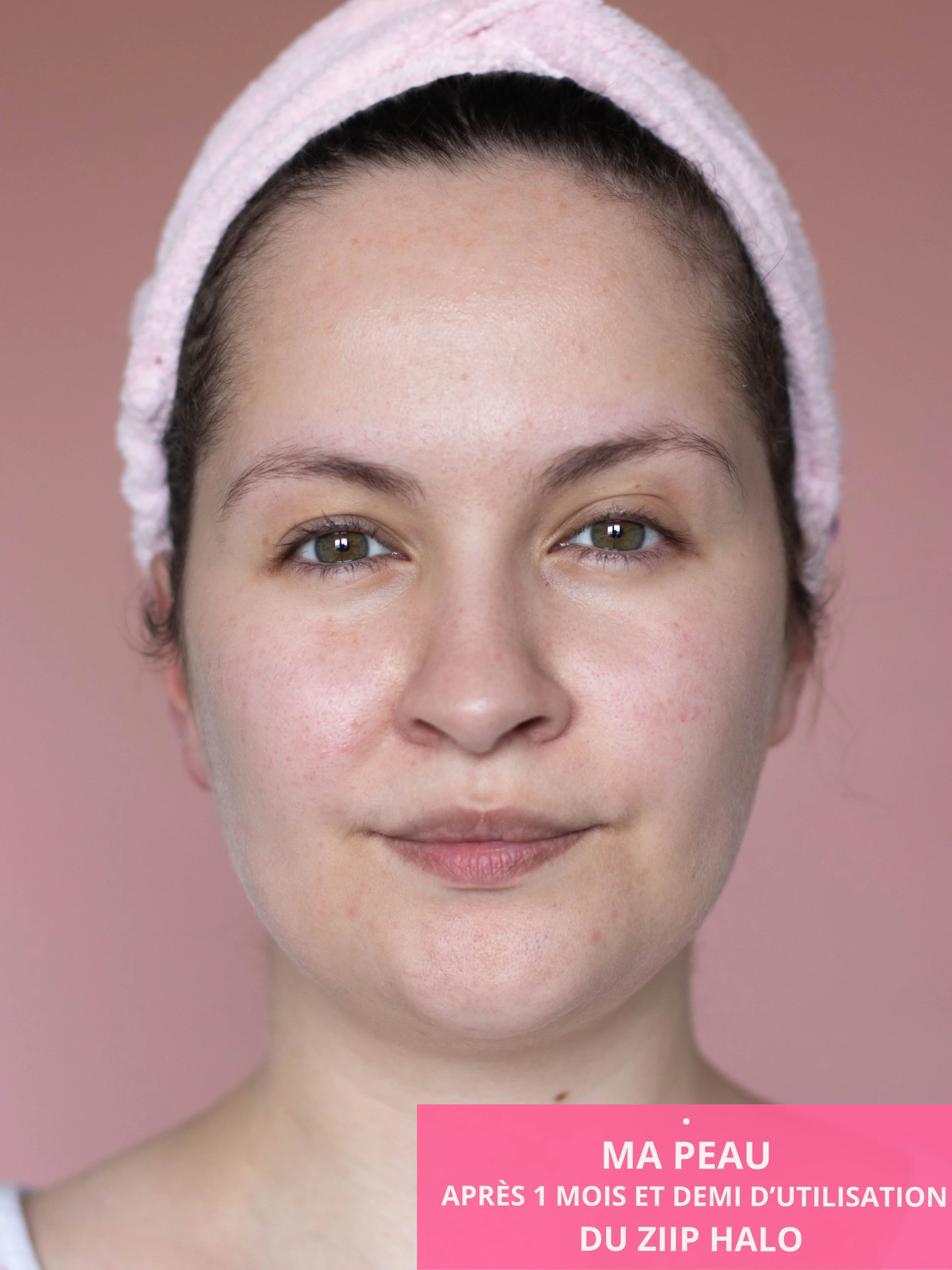 Ma peau et mon visage après un mois et demi d'utilisation régulière du Ziip Halo