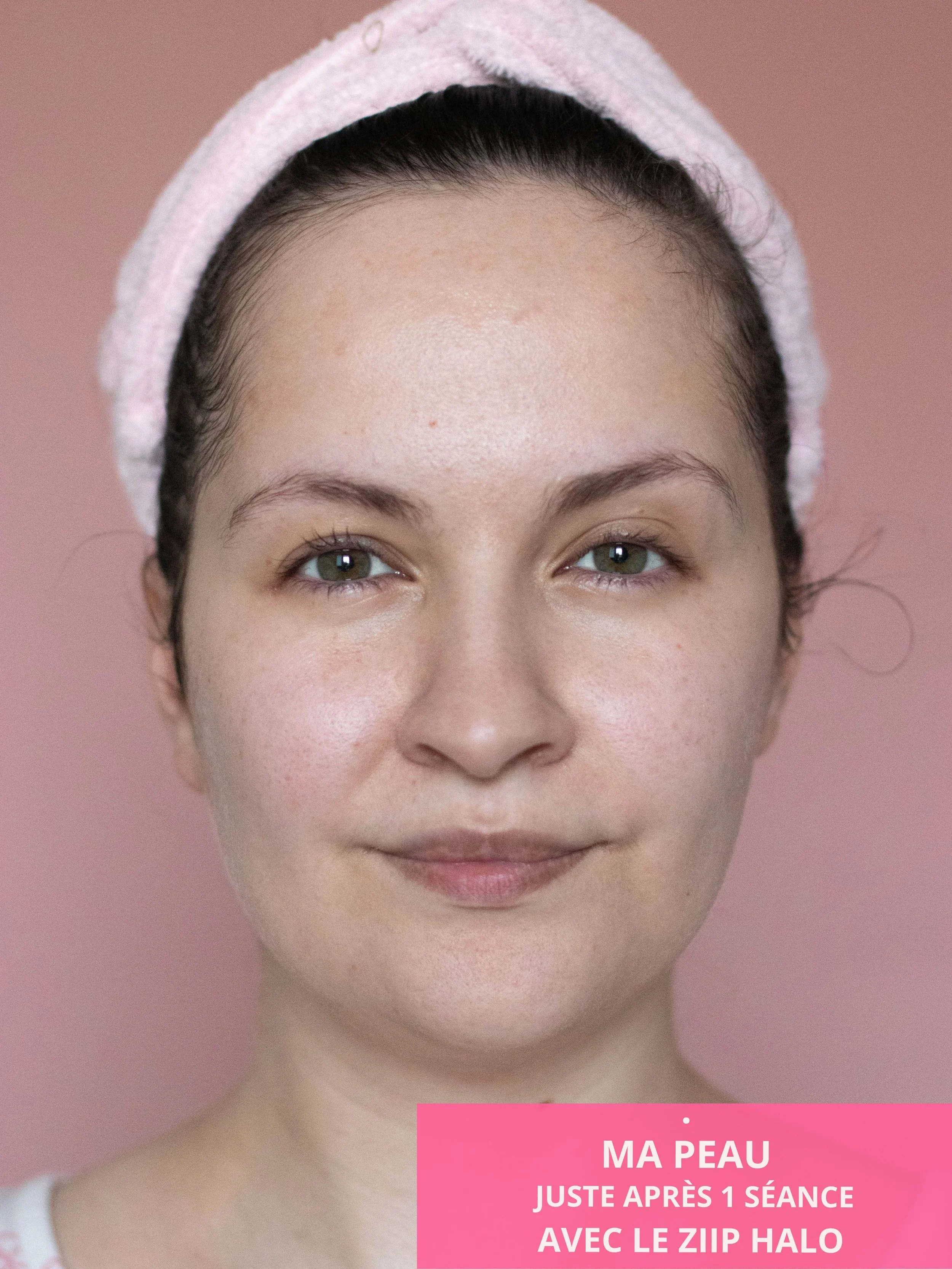 Ma peau et mon visage après avoir réalisé les soins "Boost de Collagène" et "Soin du Visage 4 minutes" disponible dans l'application Ziip Halo