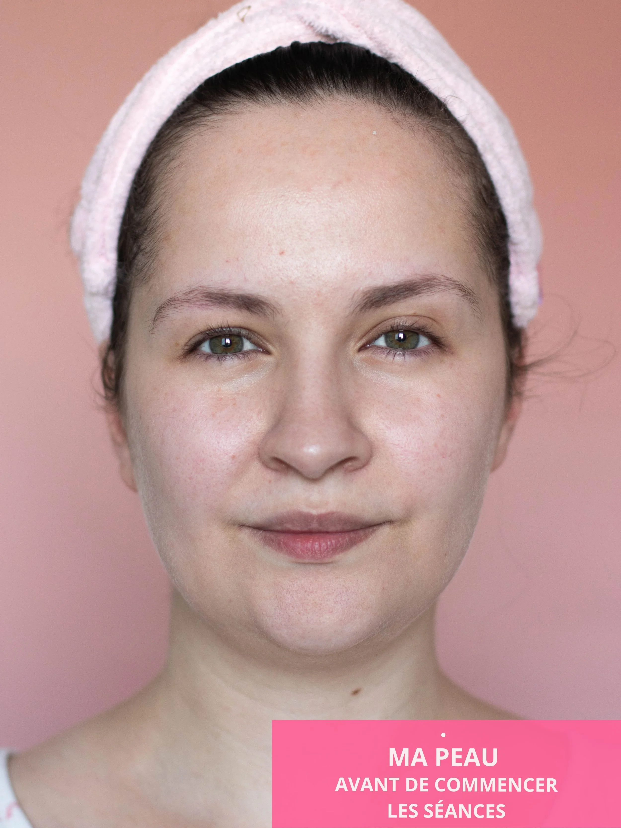 Ma peau et mon visage avant de commencer les traitements avec le Ziip Halo