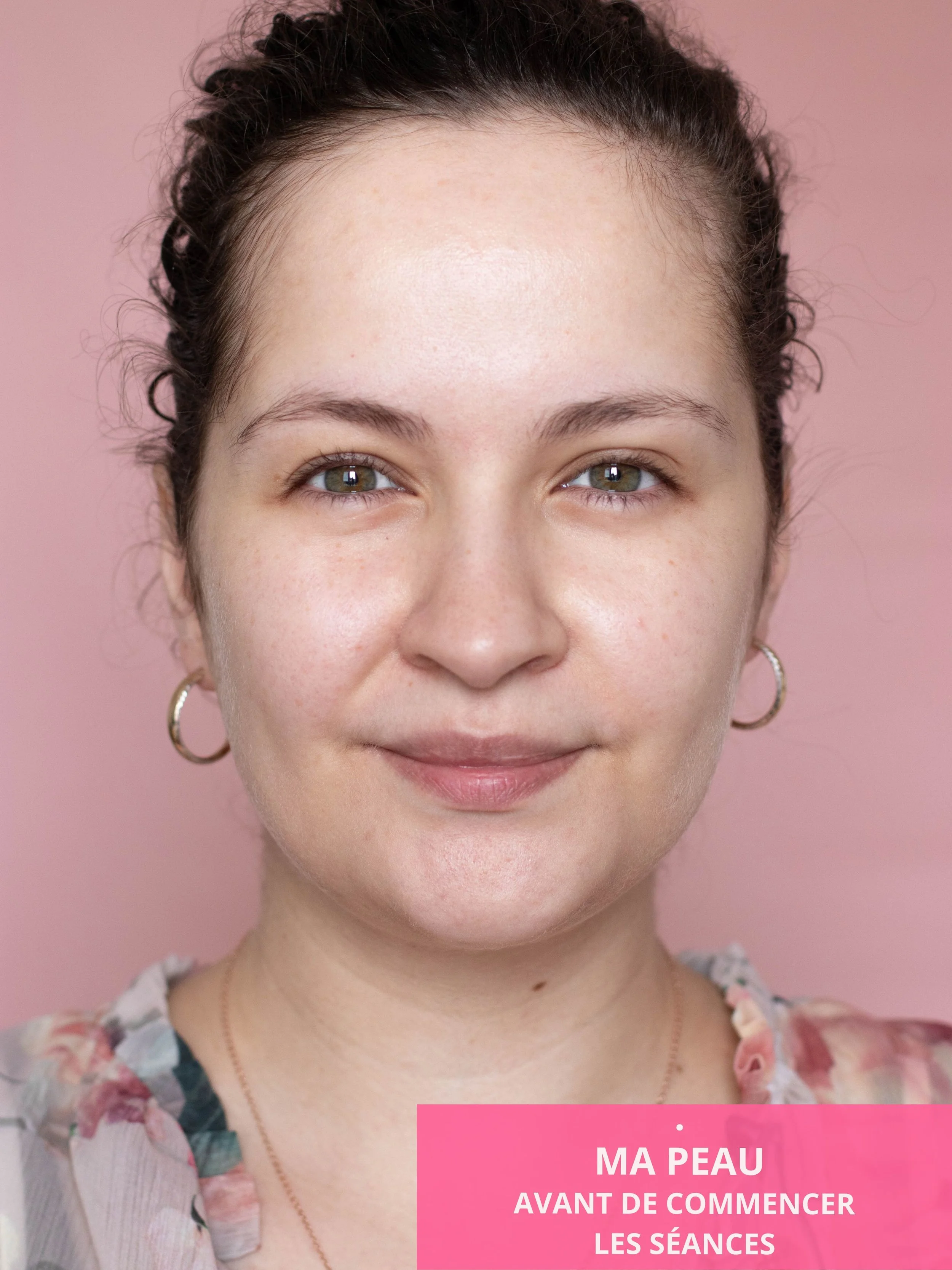 Visage avant traitement avec le Masque LED Série 2 CurrentBody