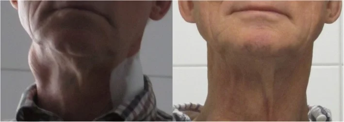 Klinisches Bild von Lymphknoten-Metastasen bei einem Patienten mit Plattenepithelkarzinom der Tonsillen vor und 16 Tage nach der ersten intra-arteriellen Infusionstherapie.