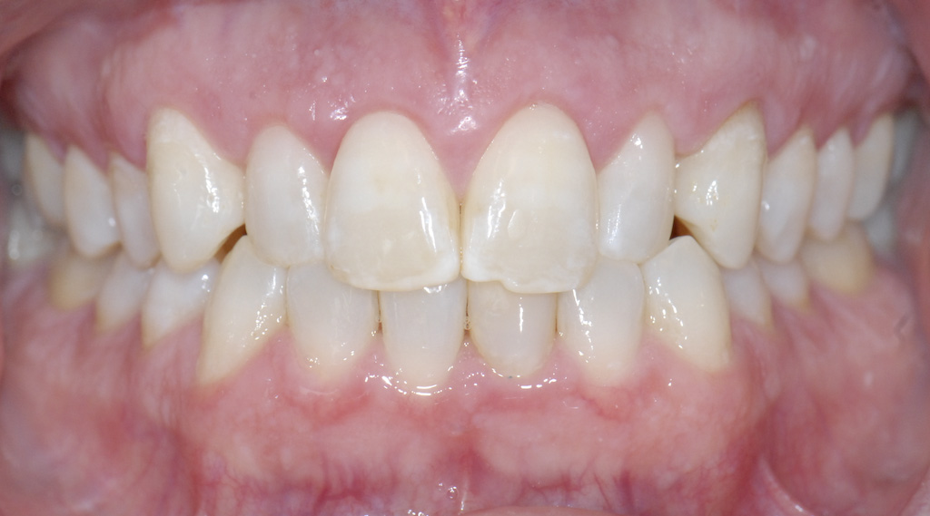 Crown Lengthening Beaverton Periodontics