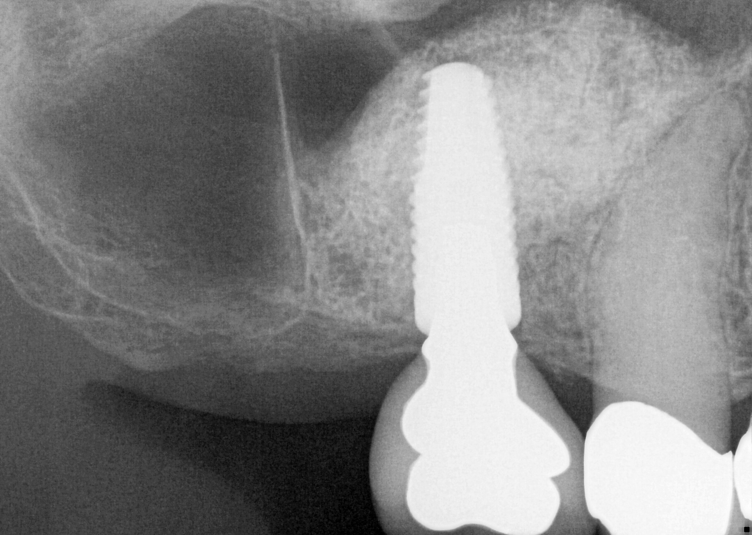 Sinus Bone Augmentation (Sinus Lift) — Beaverton Periodontics
