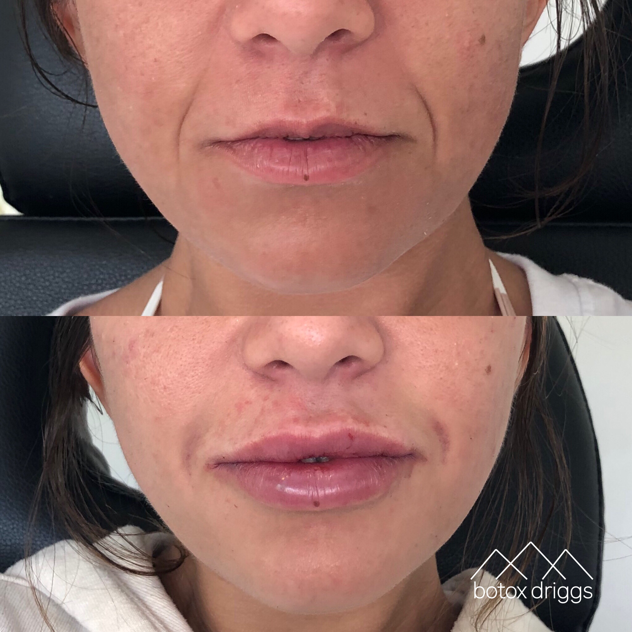 botox driggs lips with juvederm, smile lines with restylane, cheeks with voluma.PNG