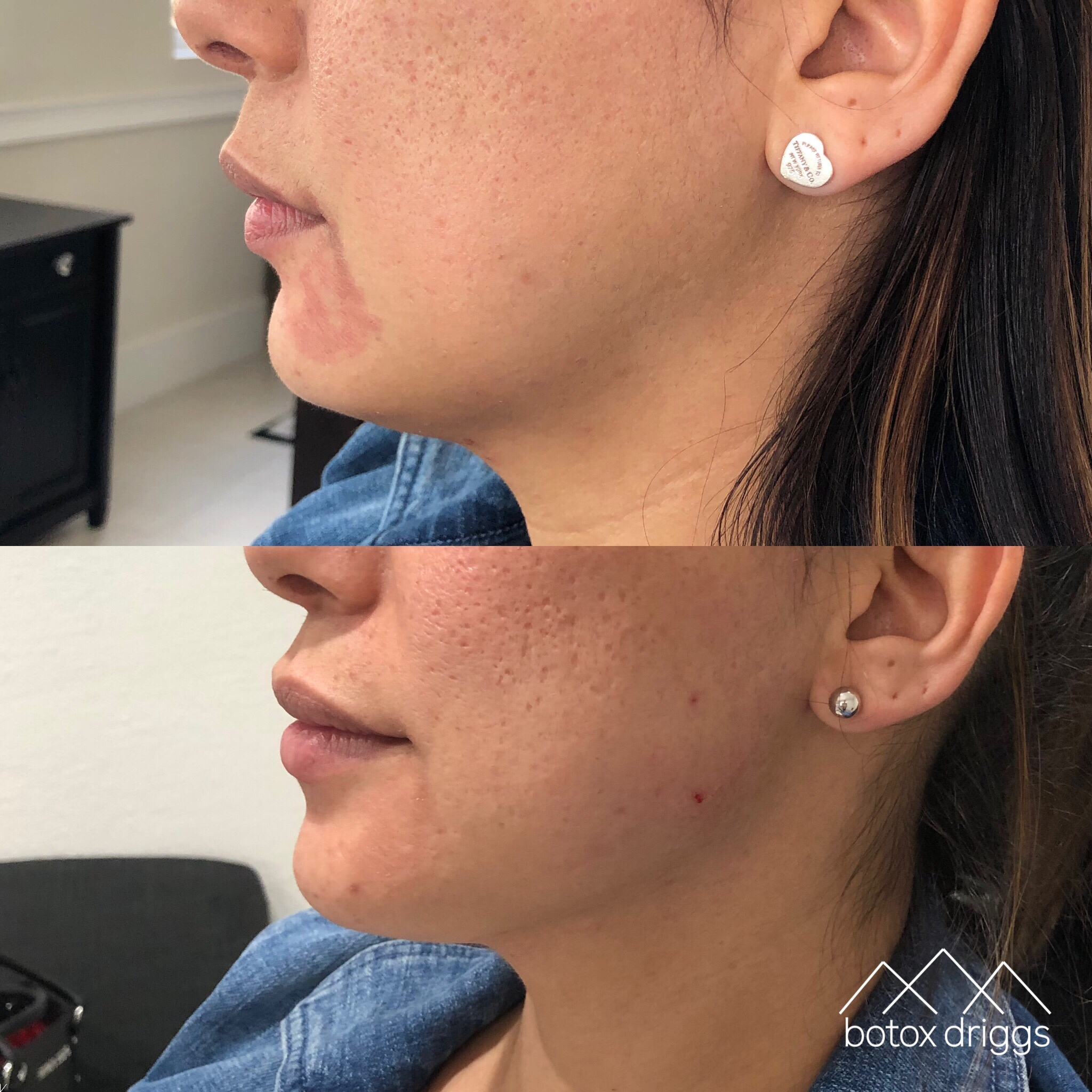 botox driggs chin with juvederm, jaw line contour with lyft.PNG