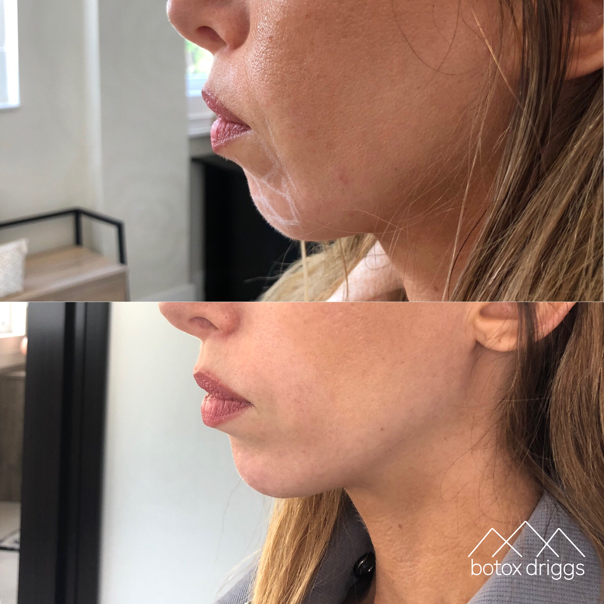 botox driggs chin.PNG
