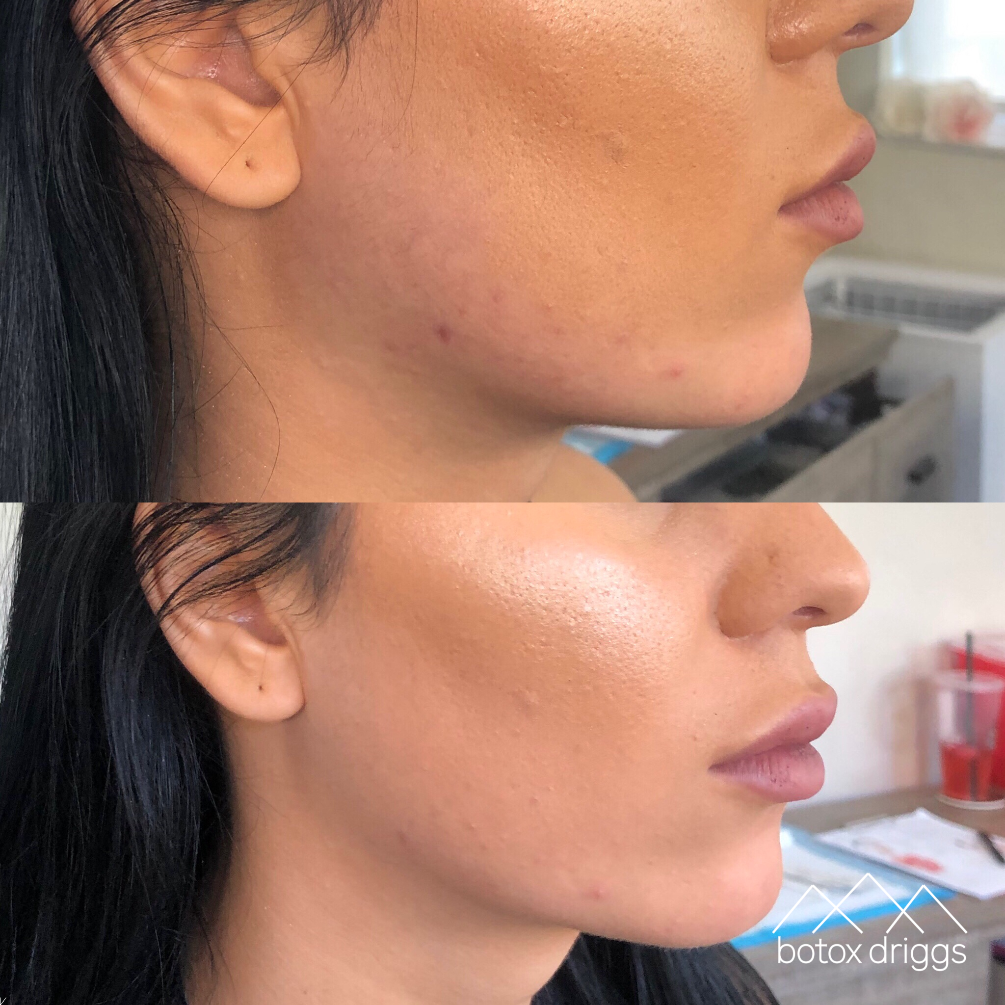 botox driggs jawline contour with lyft.PNG
