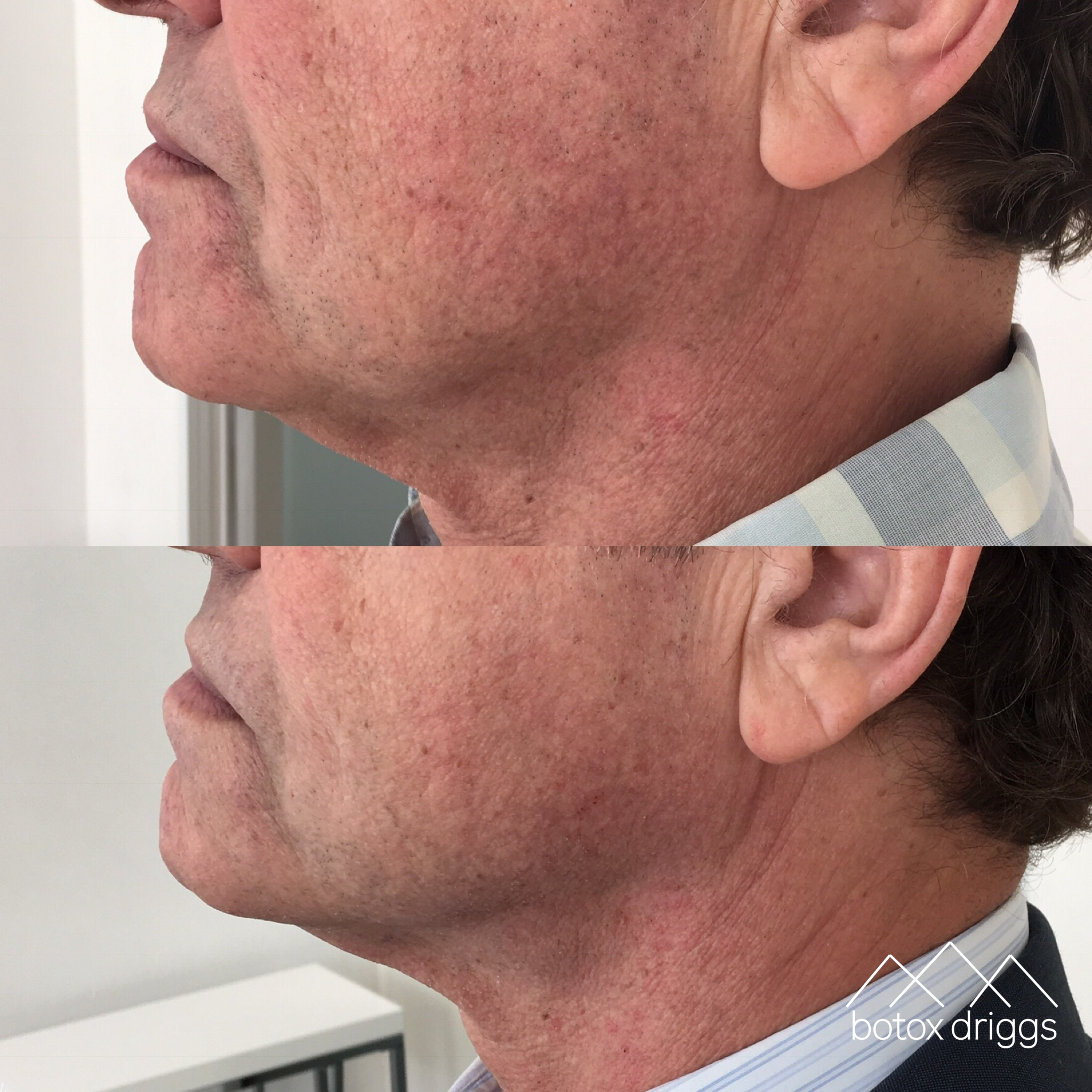 botox driggs jaw line with kybella.PNG