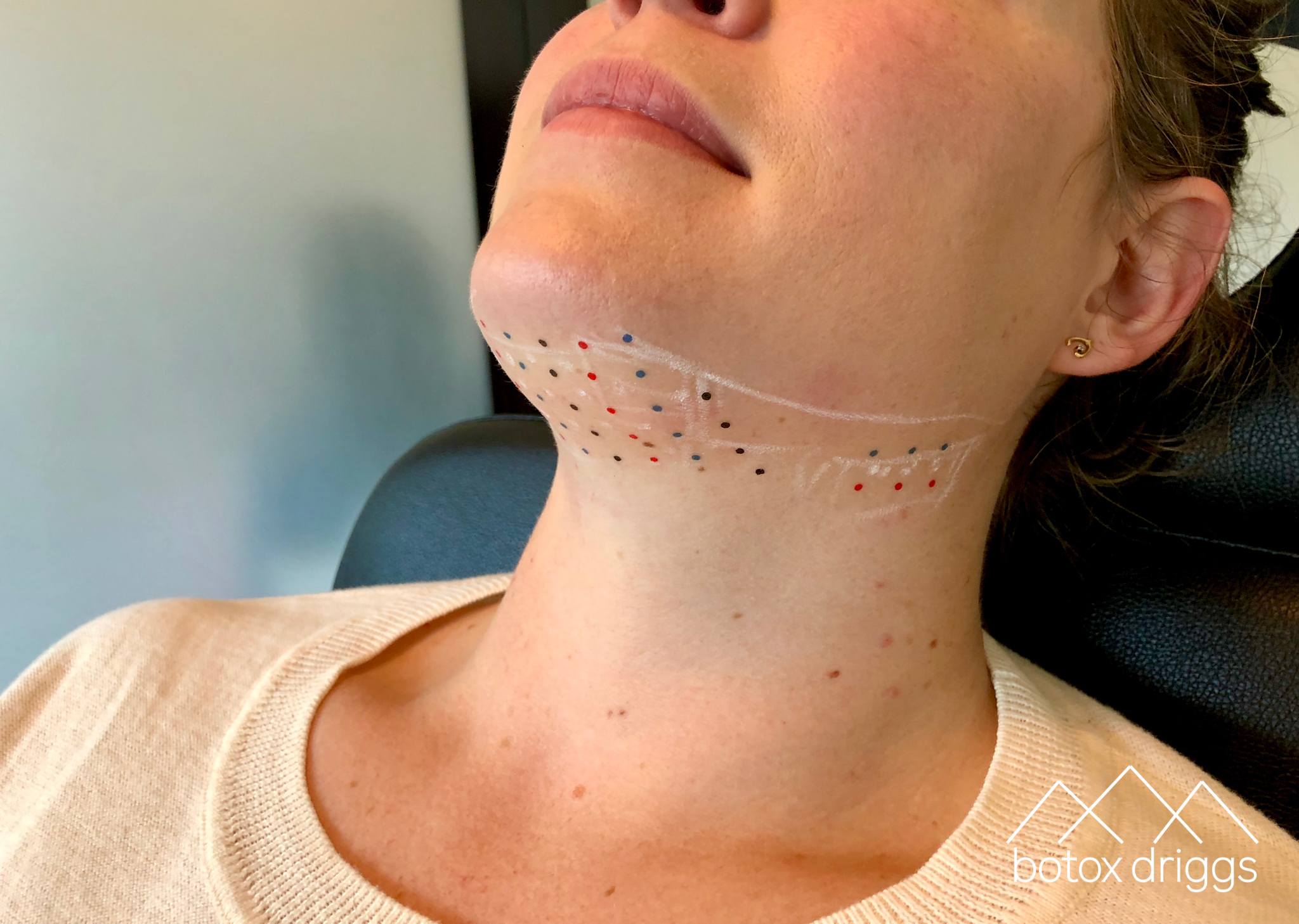 botox driggs kybella grid.PNG