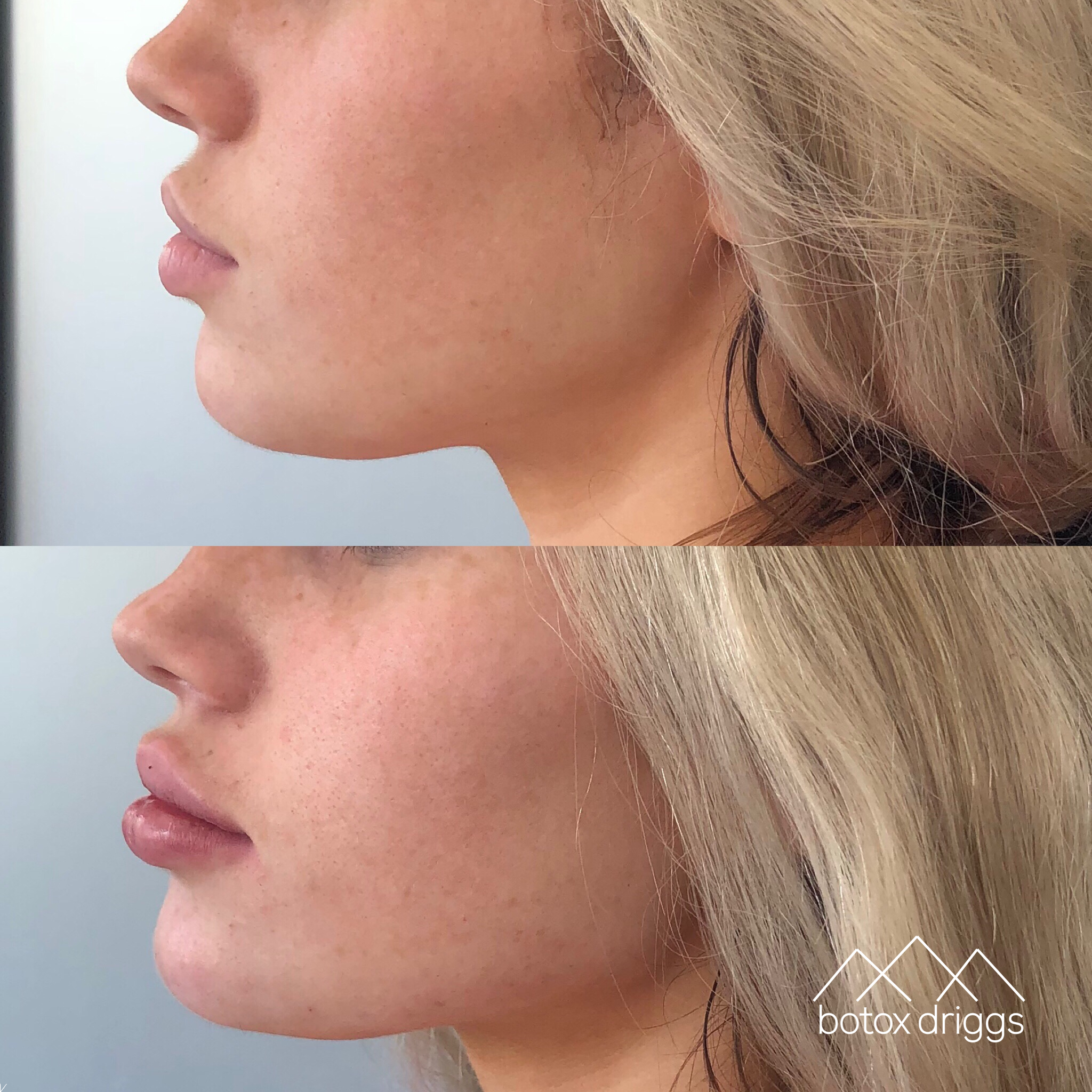 botox driggs lips with juvederm, chin with voluma, jawline with voluma.PNG