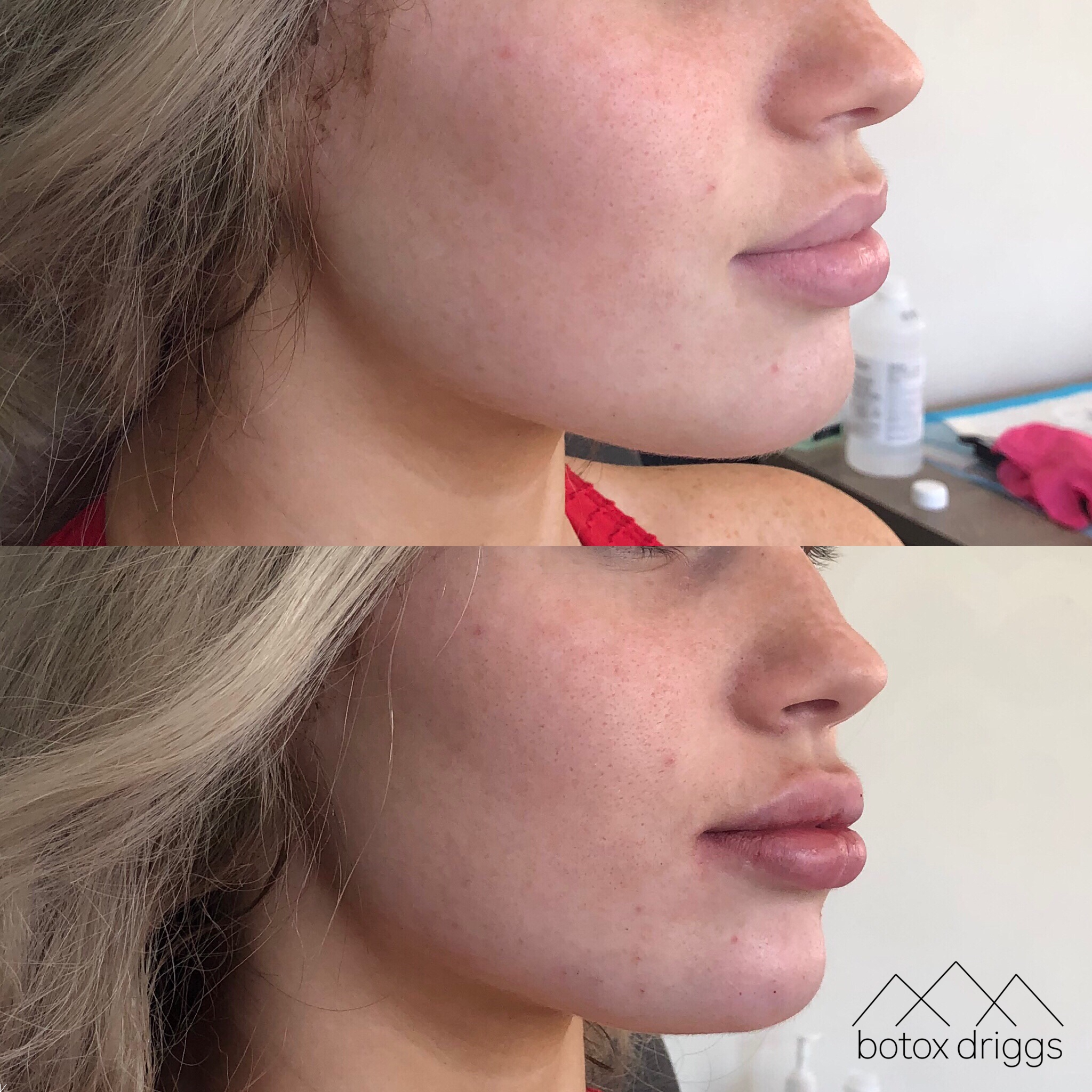 botox driggs lips with juvederm, chin with voluma, jawline with voluma2.PNG