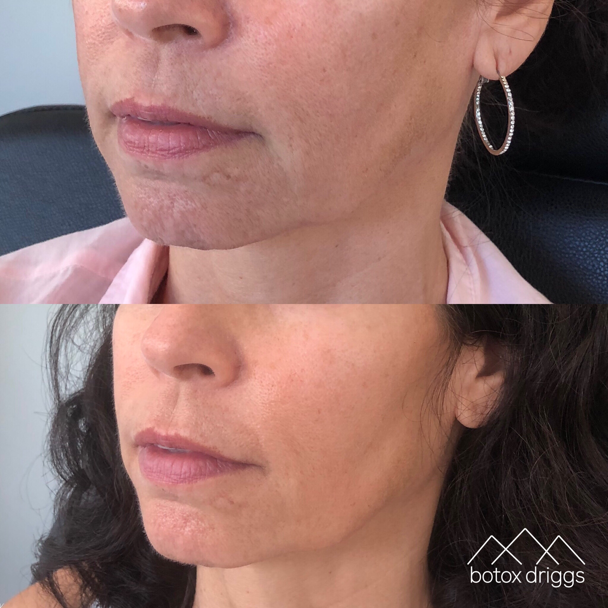 botox driggs lips with restylane and oral commisures.PNG