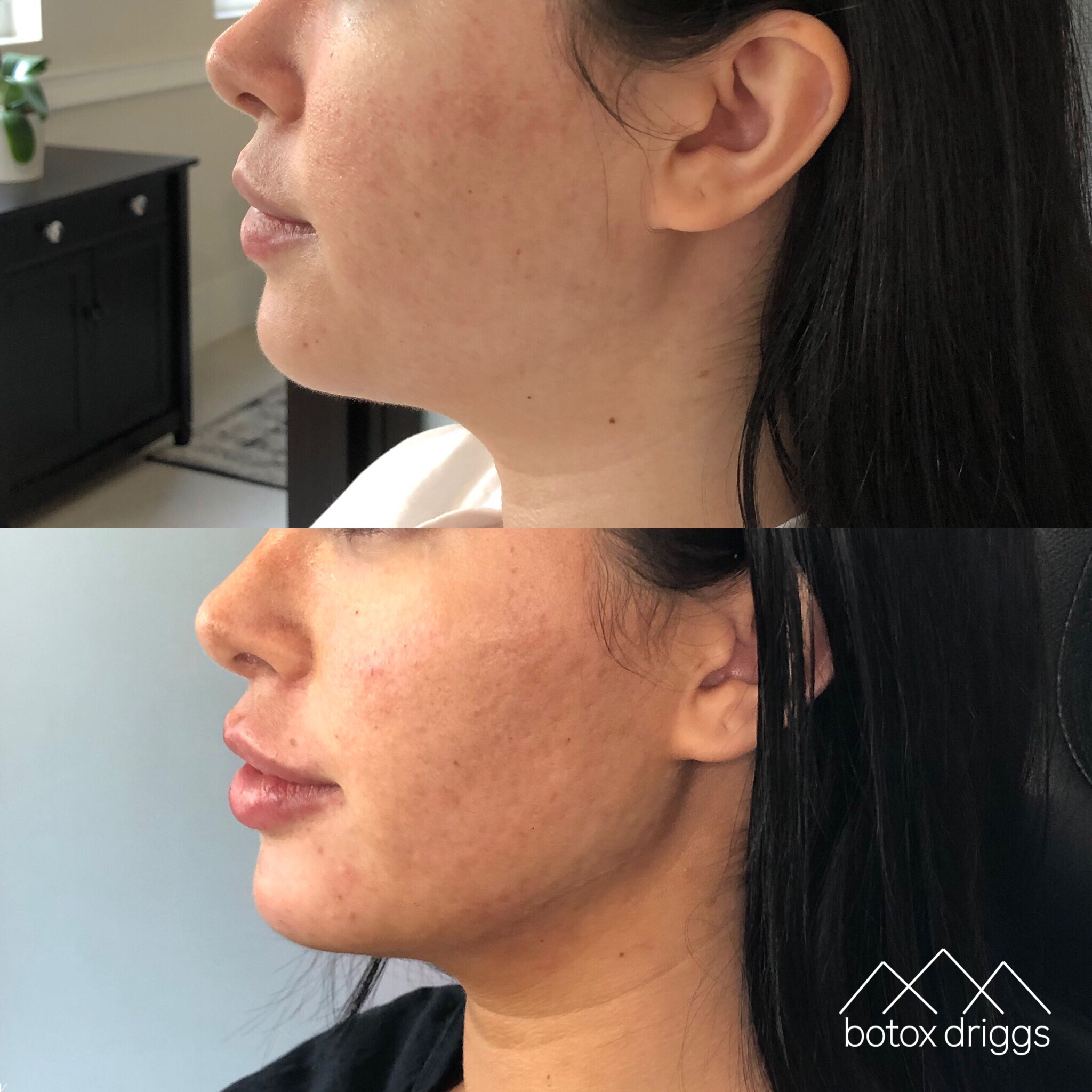 botox driggs lower face contour 2.PNG