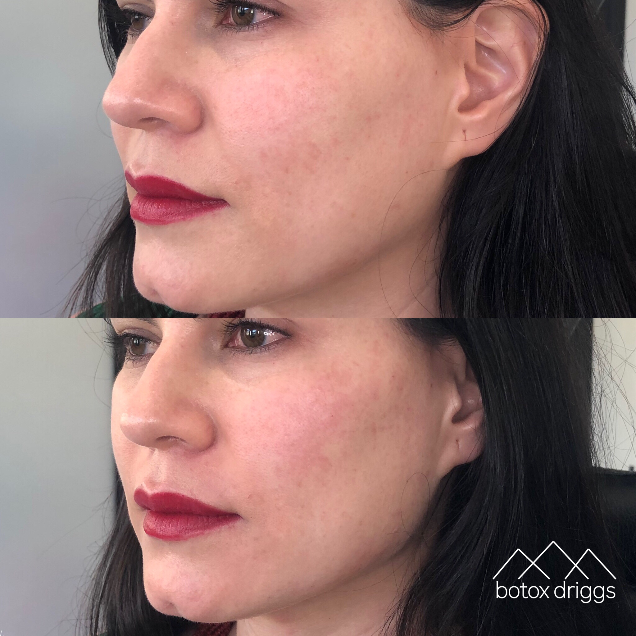botox driggs lyft AOM.PNG