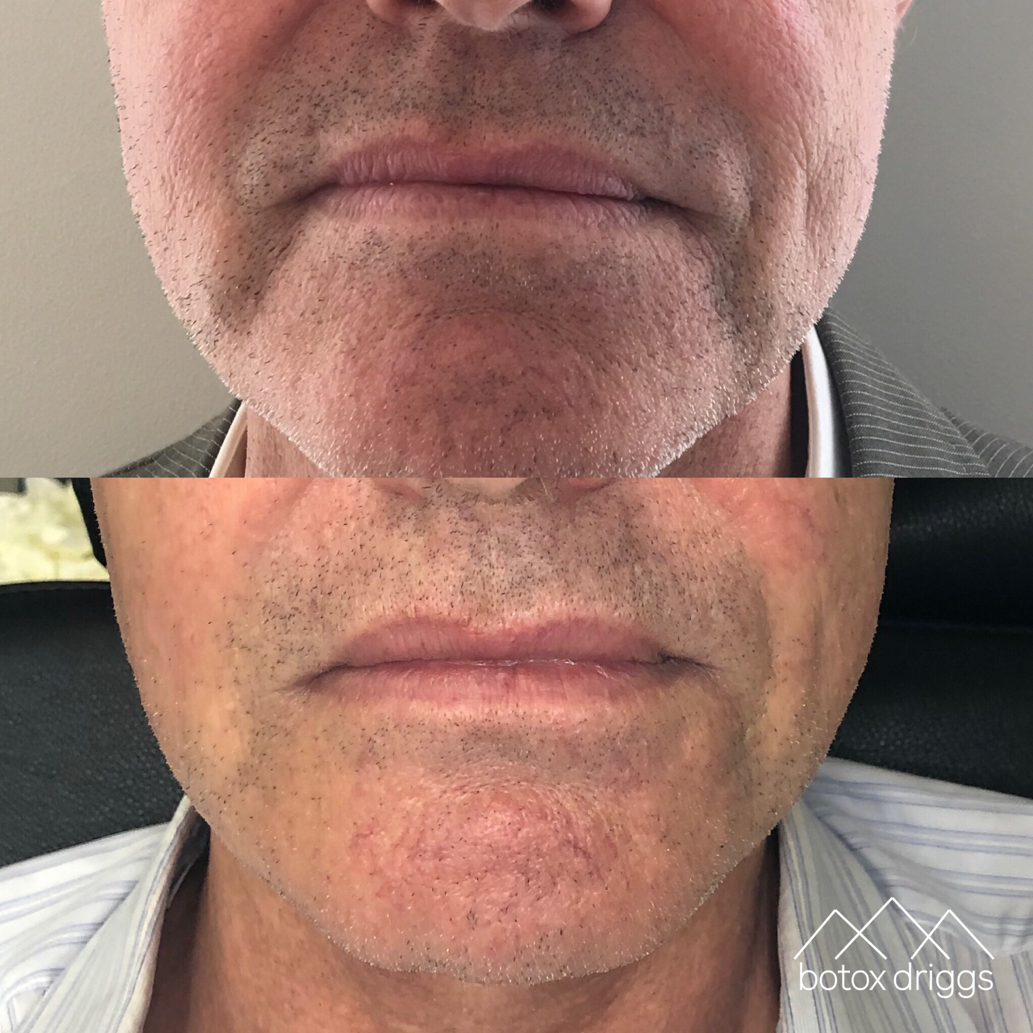 botox driggs oral commisures.PNG
