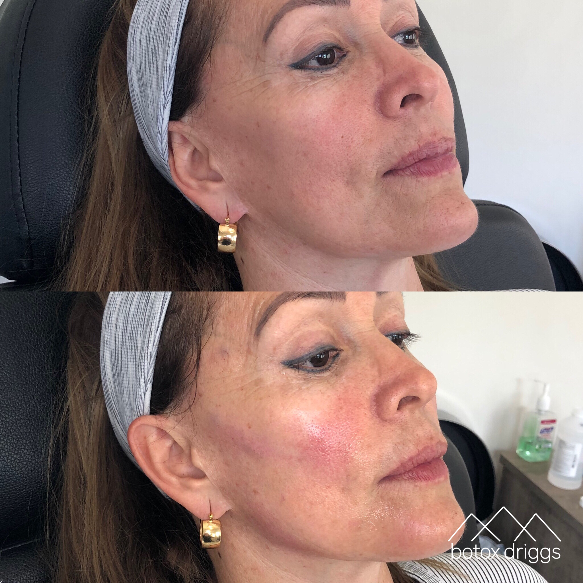 botox driggs sculptra cheeks and jawline.PNG