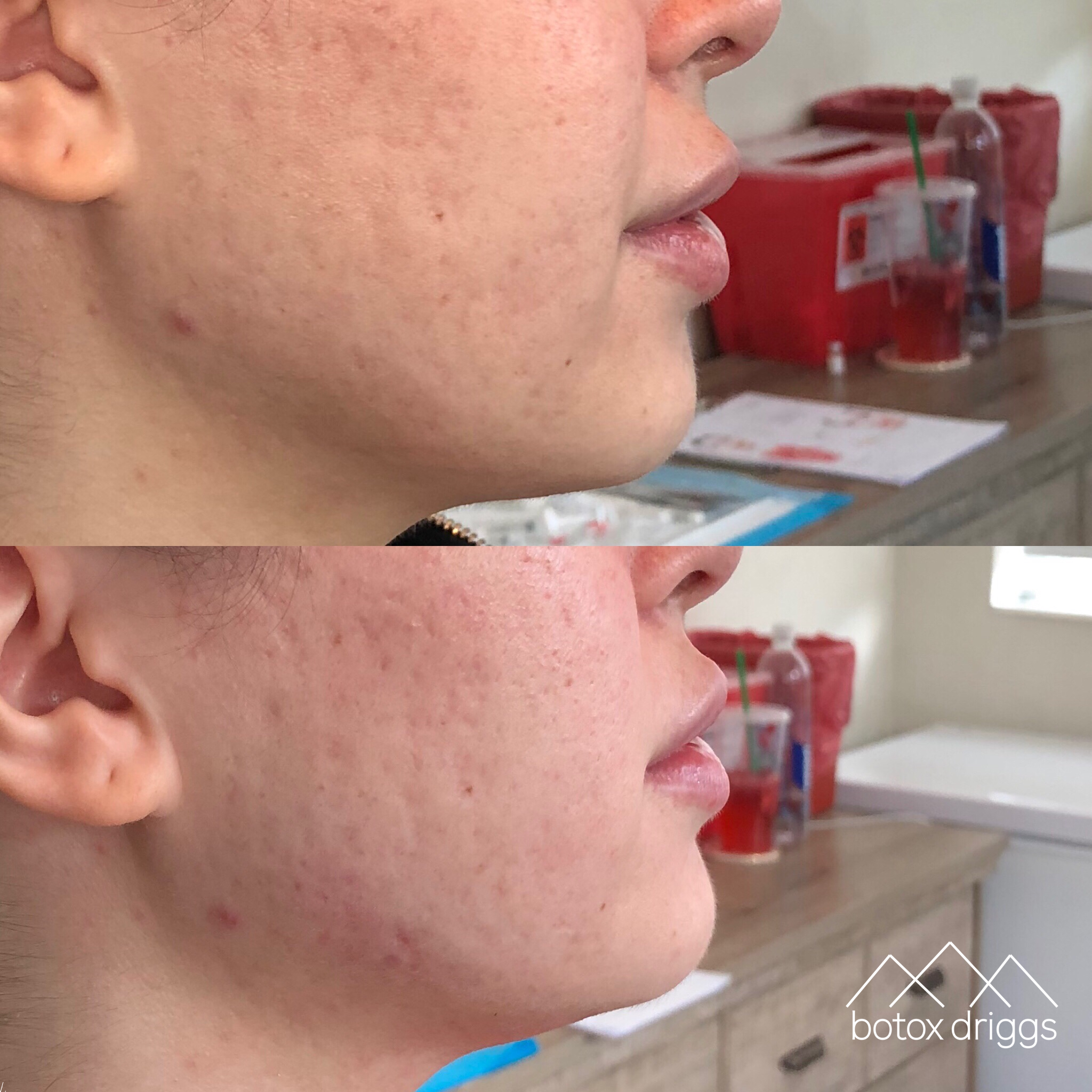 botox driggs voluma chin and apple cheeks.PNG