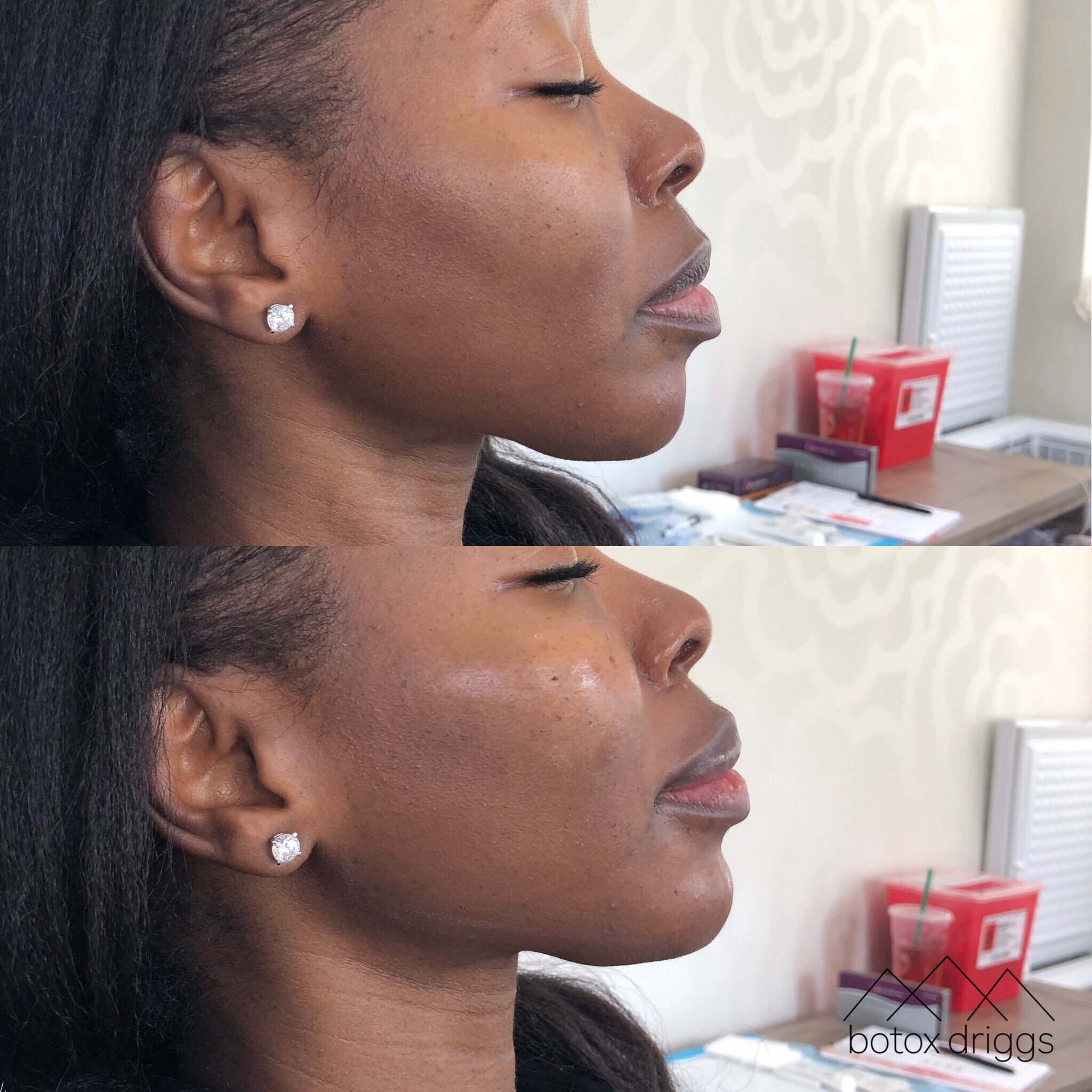 botox driggs voluma hin and jawline.PNG