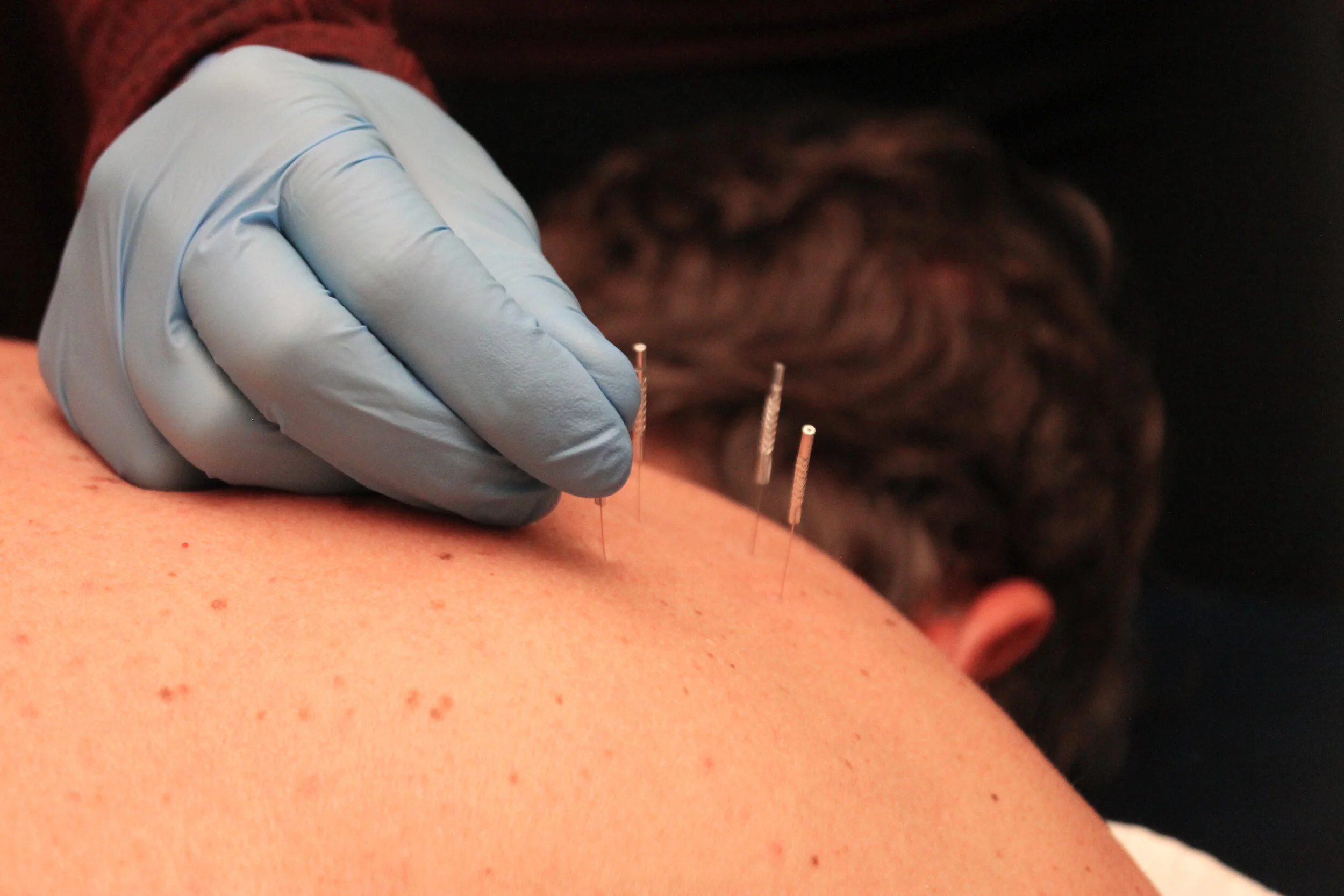 Dry Needling