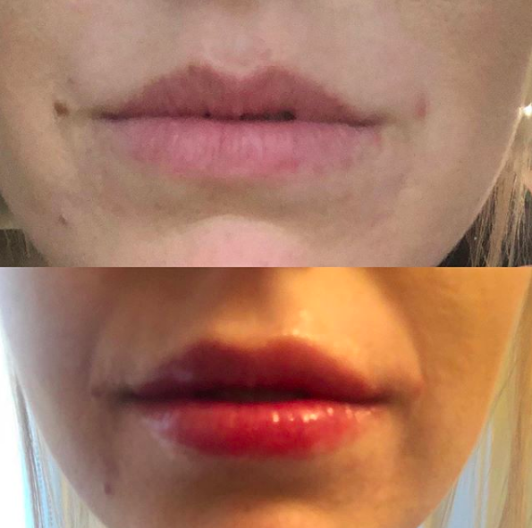Lip Filler - 1 Syringe