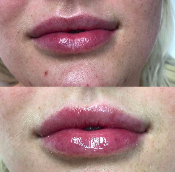 Lip Filler - Half Syringe