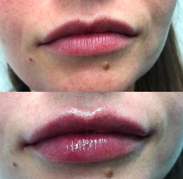 Lip Filler - 1 Syringe