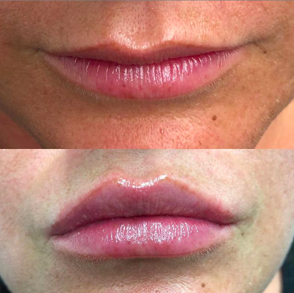 Lip Filler