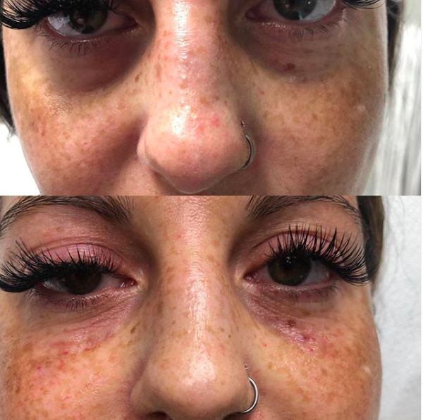 Under Eye Filler