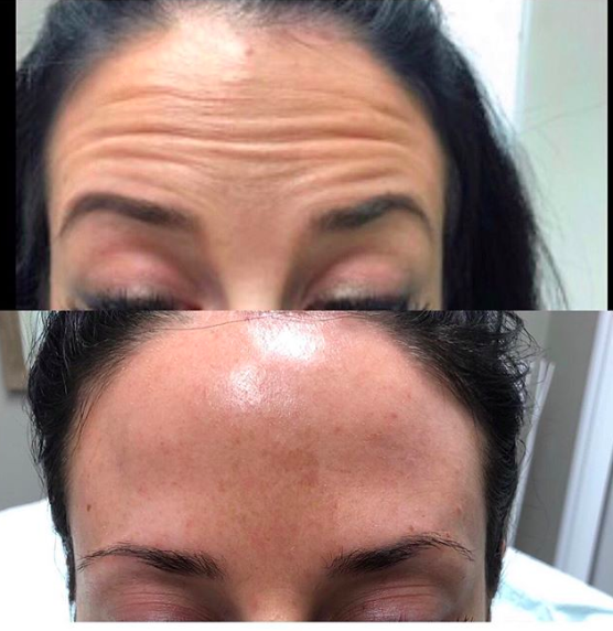 Frontalis - Botox/Dysport