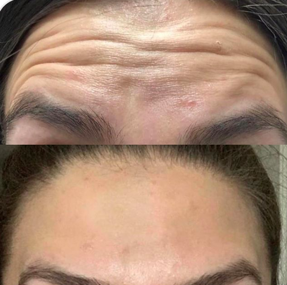 Frontalis - Botox/Dysport