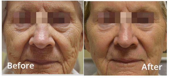 Full Face Skin Tightening