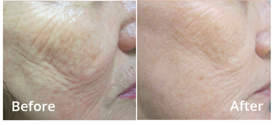 Cheek Skin Laxity