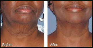 Neck and Jaw Skin Tightening