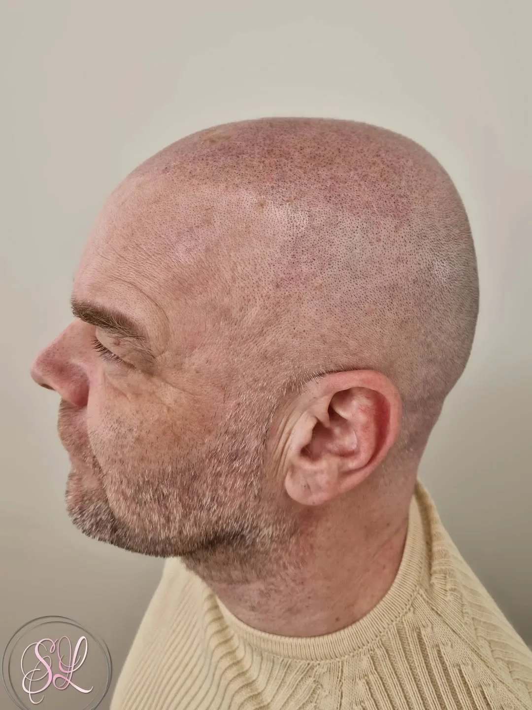 😎 H A A R L I J N ? 🤔

Een zachte haarlijn doet meer dan je denkt.
Micro Haar Pigmentatie is d&eacute; oplossing voor mannen die hun uitstraling serieus nemen. Geen ingrijpende ingreep, w&eacute;l direct resultaat.
Of je nu last hebt van inhammen, 