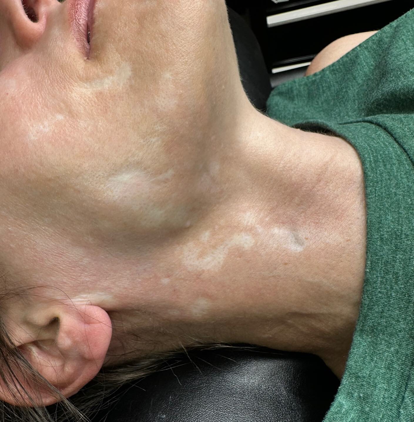 Very happy to share these beautiful results from @adorn.cosmetic on a scar camouflage project in progress! This client was in a violent attack 20 years ago and has been living with these scars since then. We are still working on the many other scars 