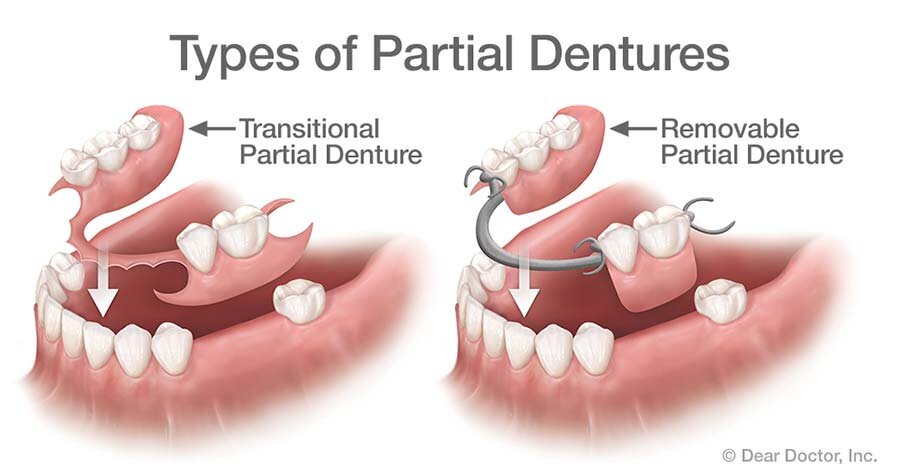 Popular Types of Partial Dentures Material - Rolando Cibischino D.M.D  Hackensack New Jersey