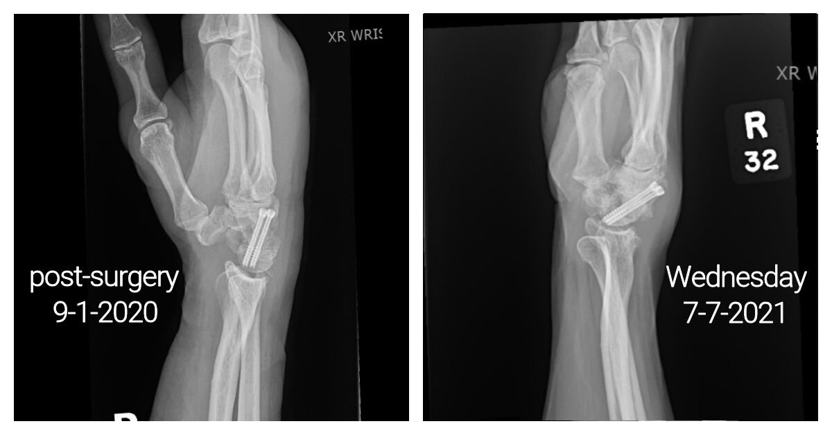 _Wrist comparison 3a.jpg