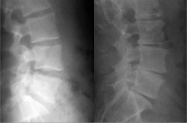 Here on the left, in a side view, we can see the disc spaces clearly, as well as the spaces behind the vertebral body out of which the nerves to the legs pass. On the right, not so much.