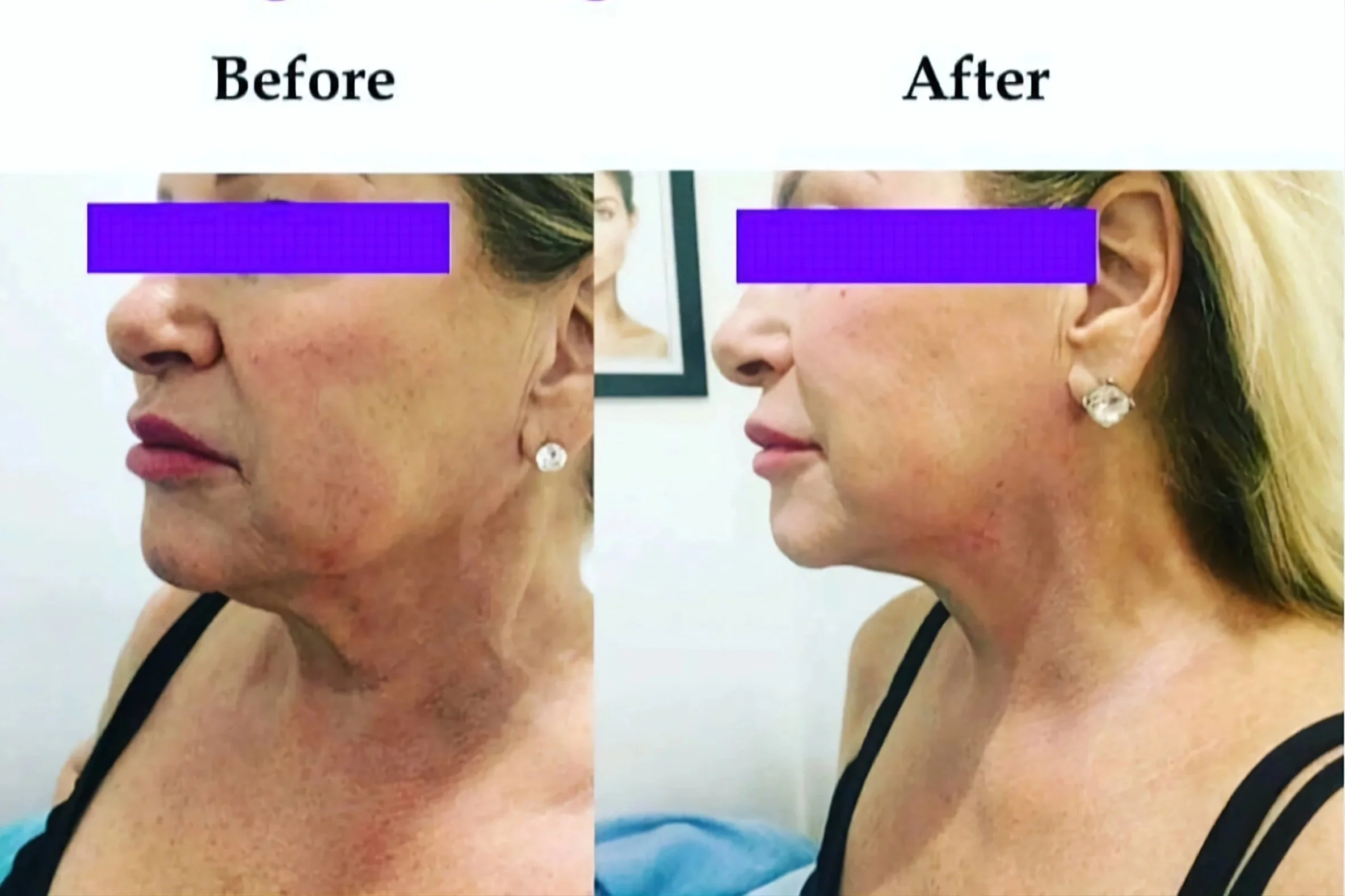 Endymed 3Deep Intensif FSR and Tightening