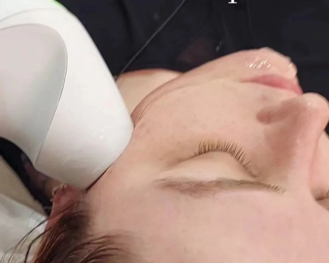 Endymed Skin Tightening and contouring with V Shaper Radio Frequency