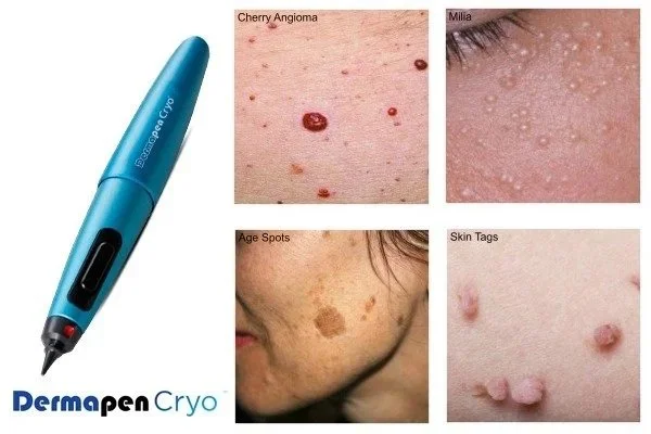 cryopen surgery for skin lesion removal
