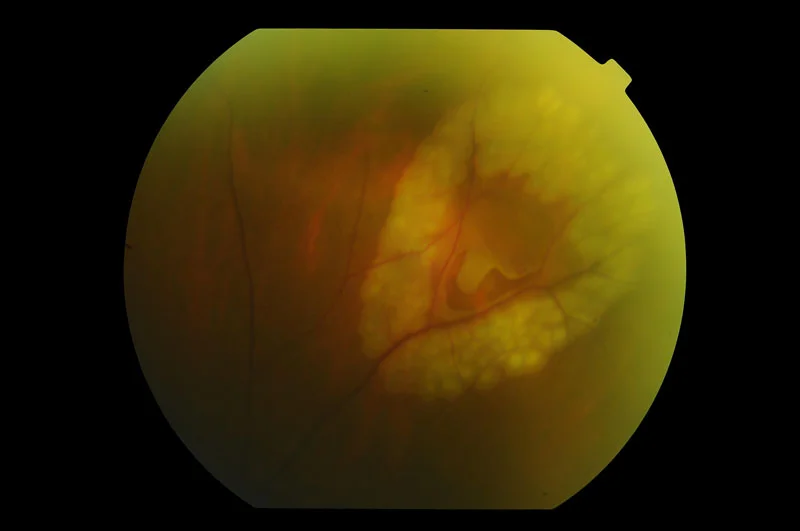 Retinal Tear or Detachment — STRATHFIELD RETINA CLINIC