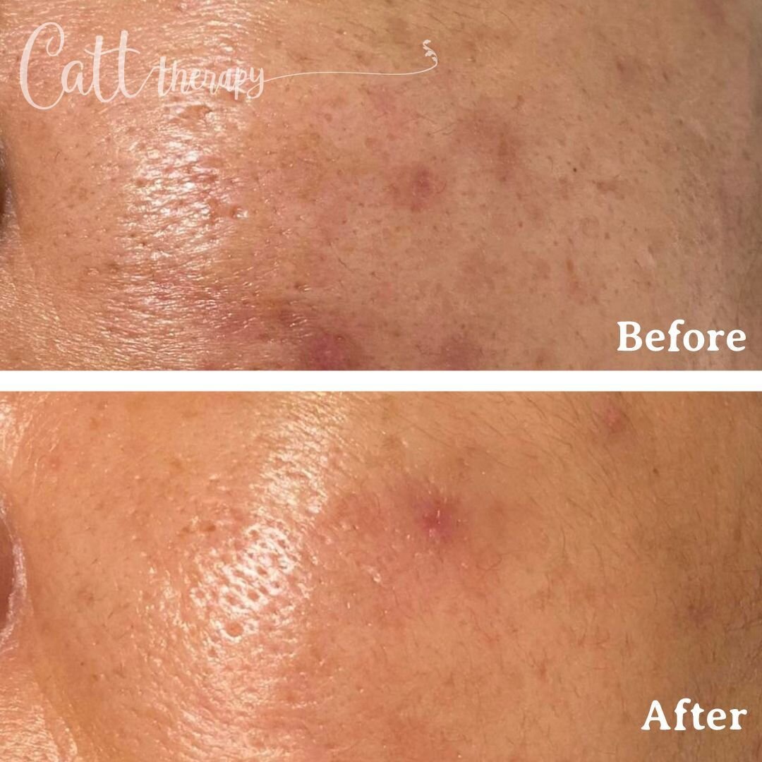 Here's a before and after of our Skin Brightening and Acne Scaring Treatment! 

Reduce the appearance of acne scaring and even out the skin tone with this treatment. 

Save 50% with this package for skin brightening and acne scarring. 

Call us on (0