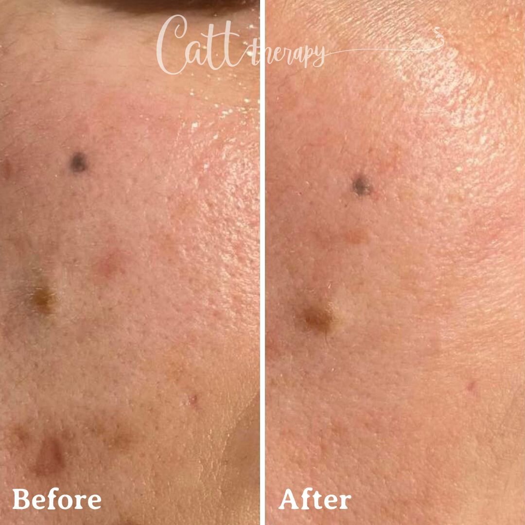 Loving the results of this reduced pigmentation before and after 😍 

Enquire now:
Call us on (02) 8605 1992 or on +61 404 340 888
Book online at www.catttherapy.com.au

#beforeandafter #results #pigmentation