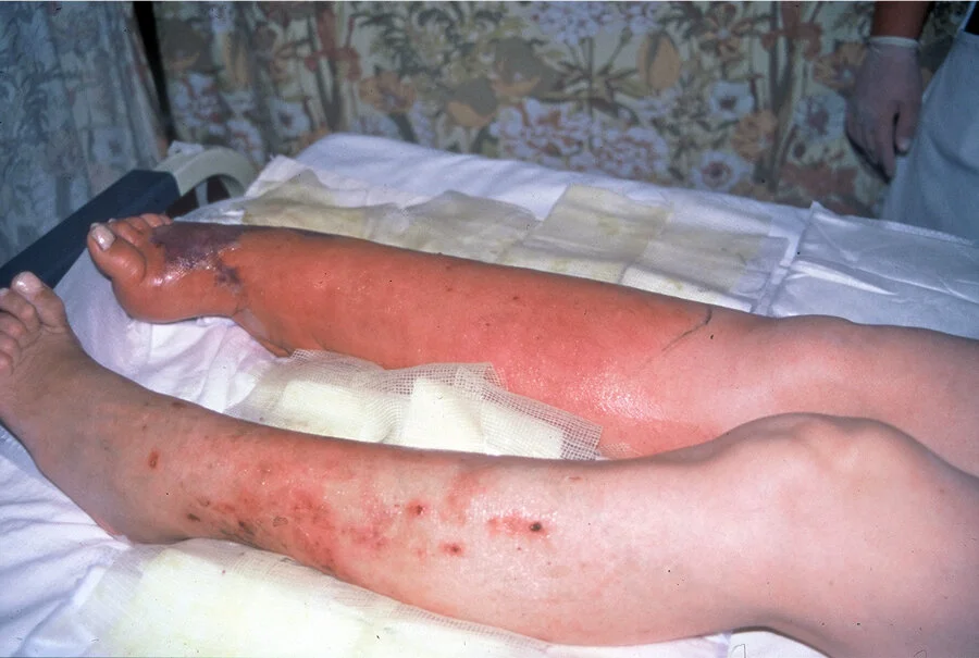 Severe infection of a previously small wound. The skin is red, hot, swollen, and painful. Note the dark purple area on the foot. This is a life-threatening necrotizing fasciitis. The patient will have severe pain, a high temperature, and become septic.
