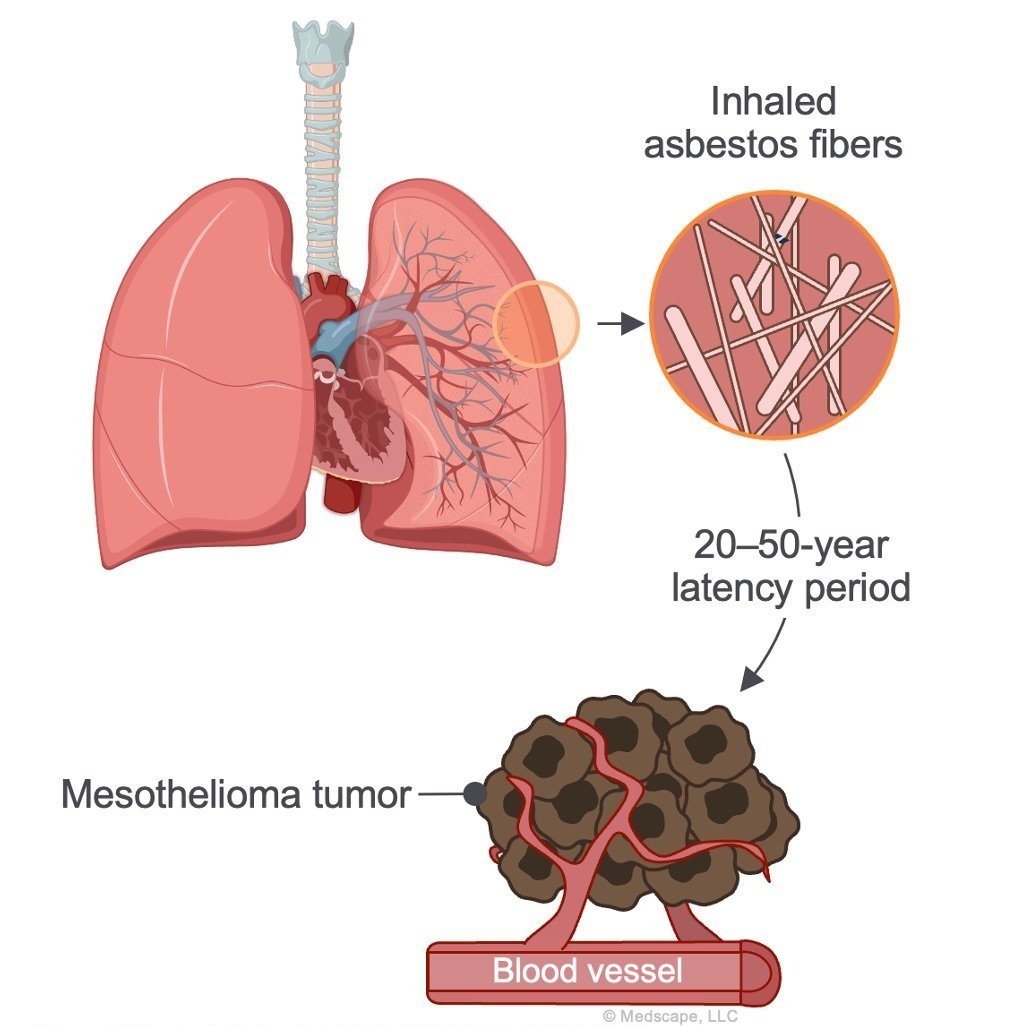 Asbestos in the Lungs