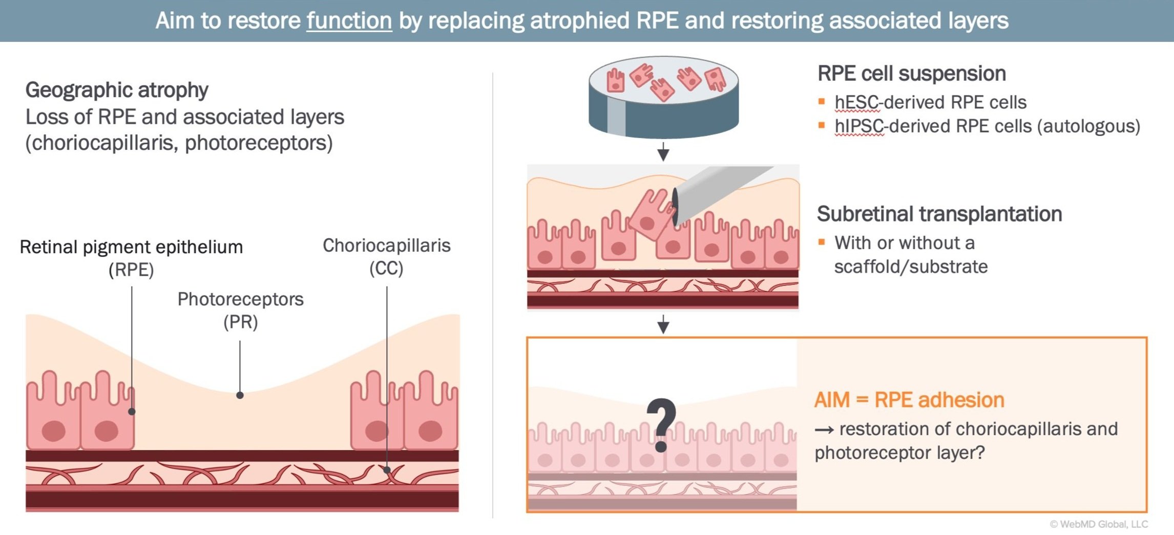 Retinal Pigment Epithelium Replacement Therapy