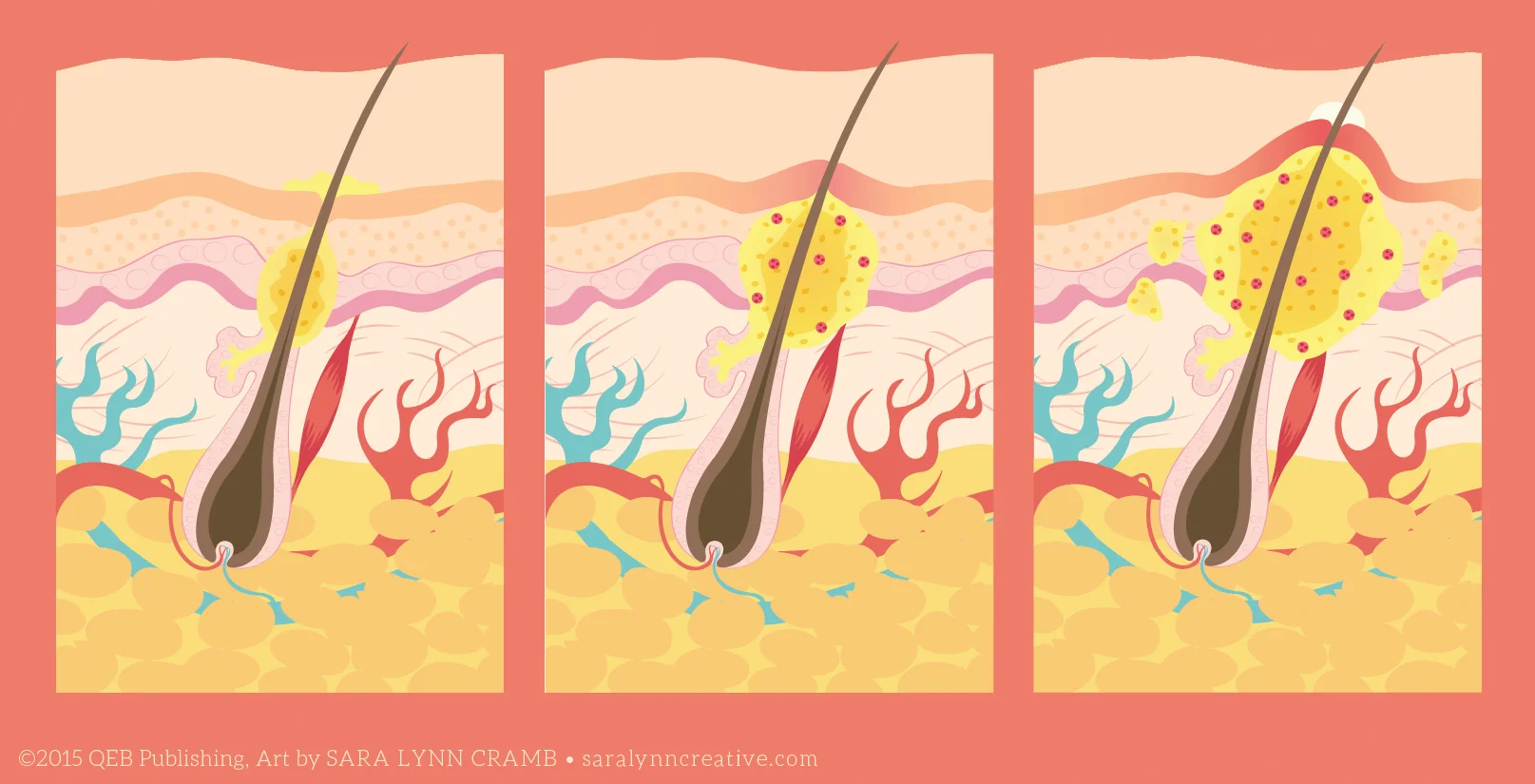 Pimple Formation