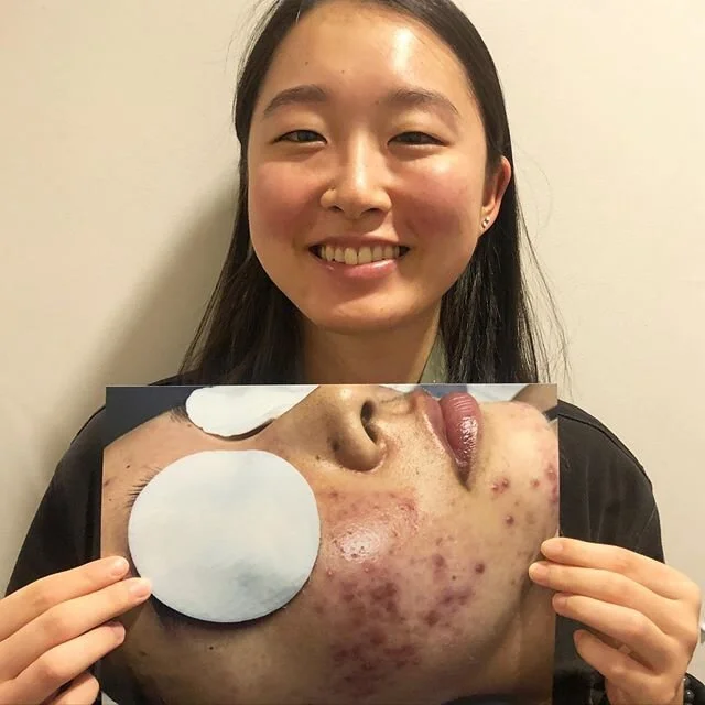 Results after Acne Bootcamp with Zaida